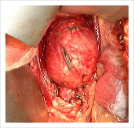 Abdominal Aortic Aneurysms