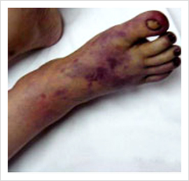 Acute Limb Ischaemia