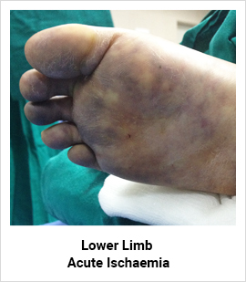 Lower Limb Acute Ischaemia