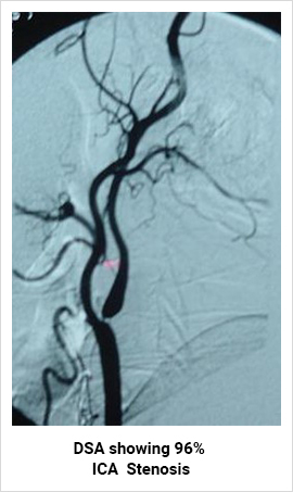 Carotid Angiography