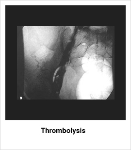 Deep Vein Thrombosis Treatment in Mumbai by Dr. Pankaj Patel