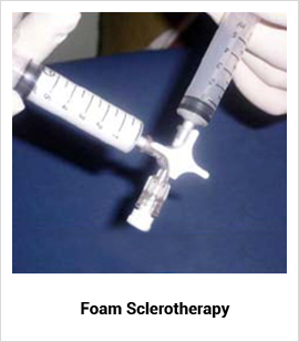foam-sclerotherapy