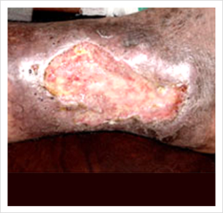 Leg Ulcer