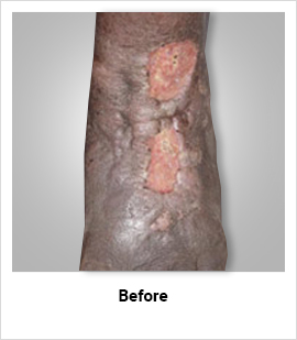 Venous Ulcer