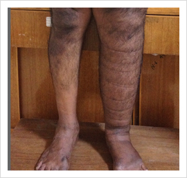 Lymphoedema