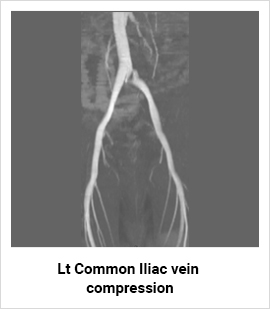 Common Iliac Vein Compression