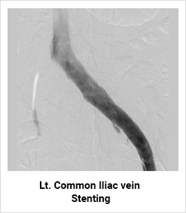 Common Iliac Vein