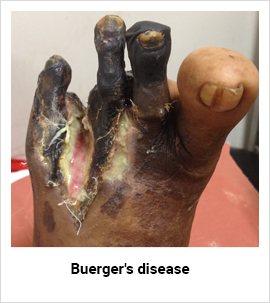 Buerger's Disease