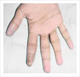 Raynaud's Disease