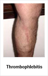 Varicose Veins