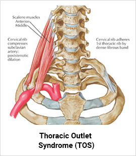 Thoracic Outlet Syndrome