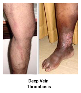 Deep Vein Thrombosis