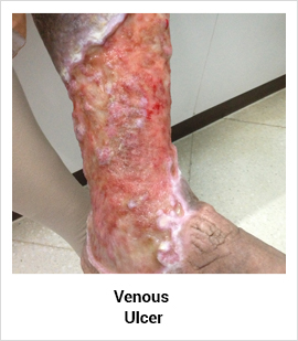 Venous Ulcer