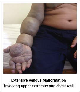 Venous Malformation