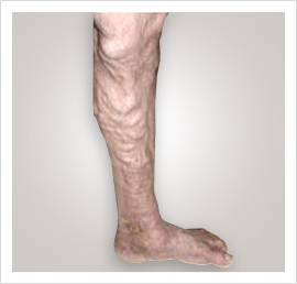 Varicose Veins